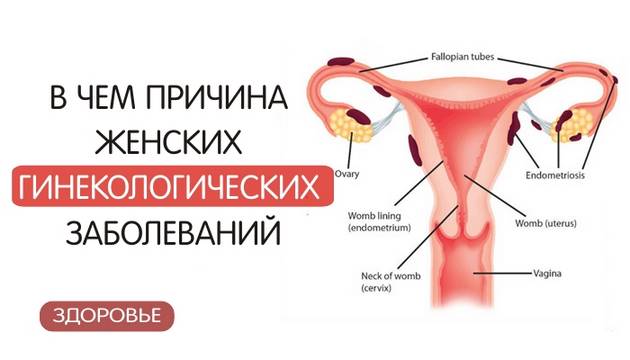 Основная причина гинекологических заболеваний у женщин