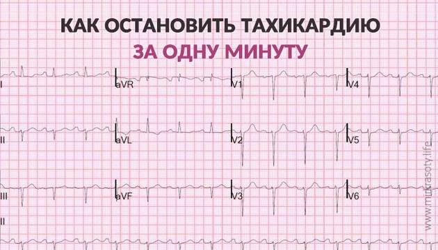 Тахикардию можно остановить за одну минуту