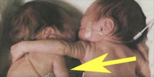 Младенец был при смерти, но когда медсестра положила рядом его близнеца, чтобы они попрощались, произошло чудо