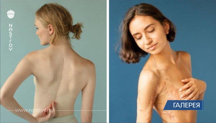 Фотопроект: люди показывают свои шрамы и рассказывают о том, как их получили