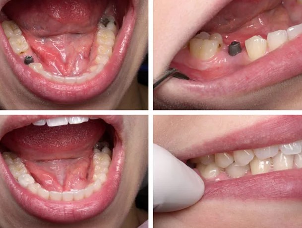 Зубные импланты из стволовых клеток: Новые зубы растут за 2 месяца! Вставная челюсть не понадобится!