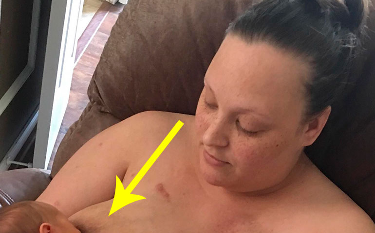Женщина показала, как выглядит ее грудь после удаления молочной железы, чтобы…