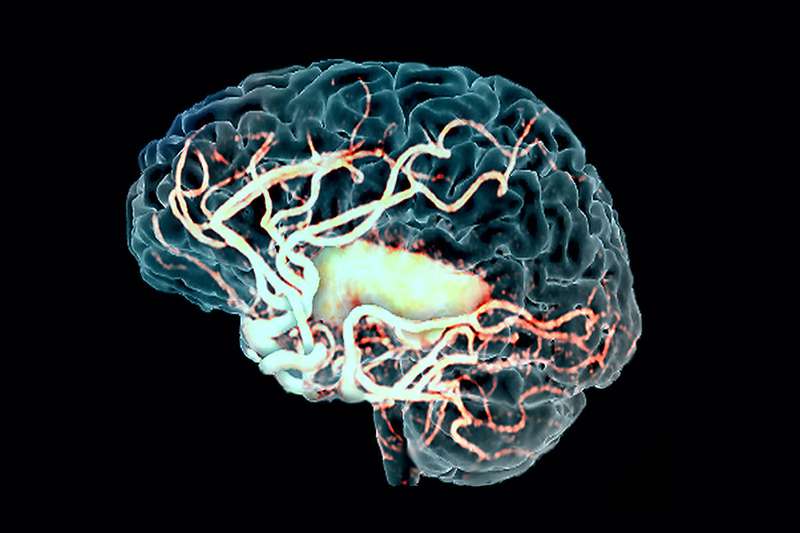 Что такое очаговое изменение вещества мозга дистрофического характера?