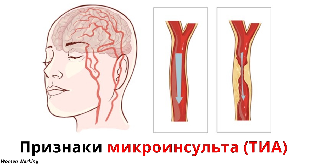 Признаки микроинсульта: Информация, которую должна знать каждая женщина