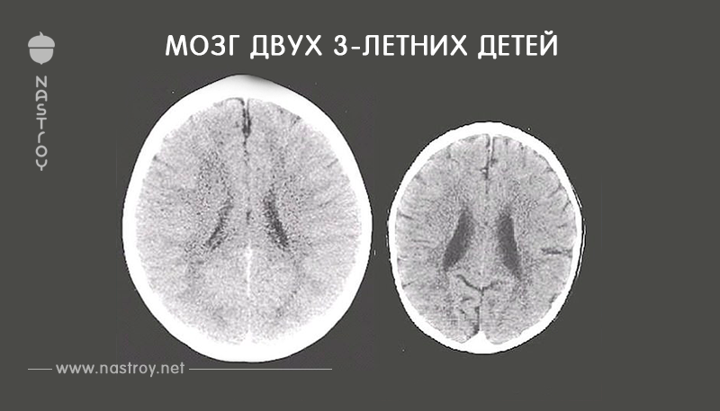 Вот мозг двух 3 летних детей: у одного хорошие родители, у другого – плохие