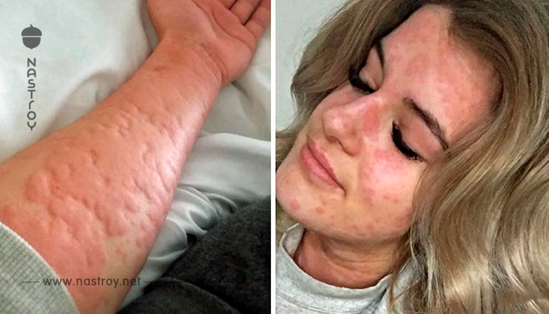 21 летняя девушка страдает от ″аллергии на зиму″. Это реально страшно!