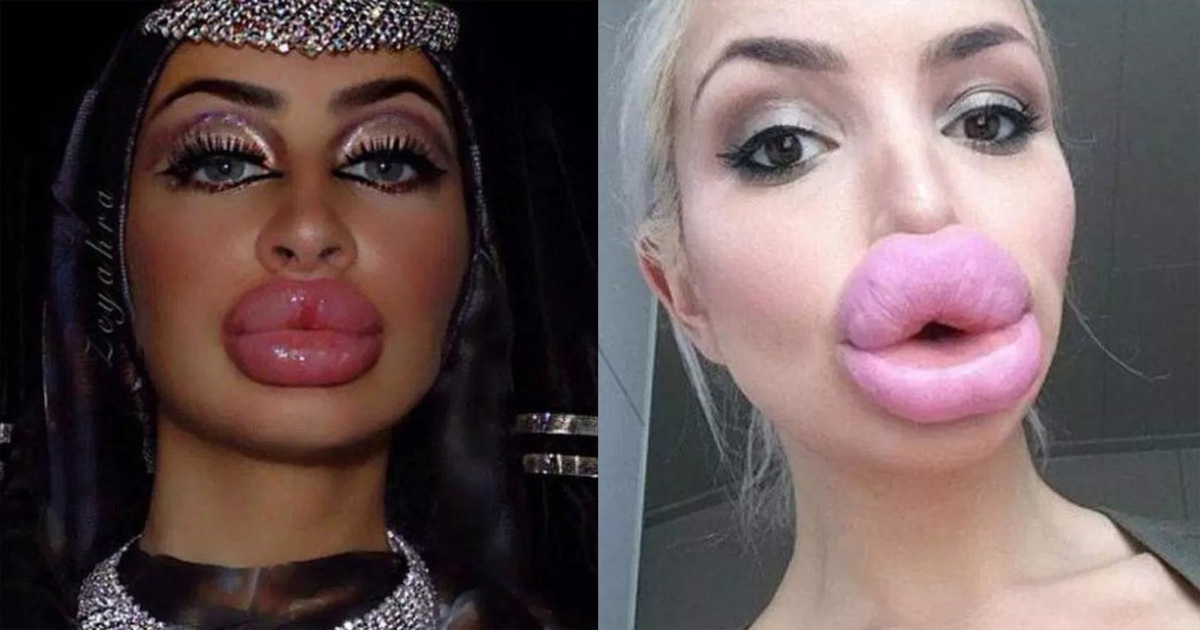 10 раз, когда кто то сделал себе ″красивые губы″, хотя больше похоже на диагноз