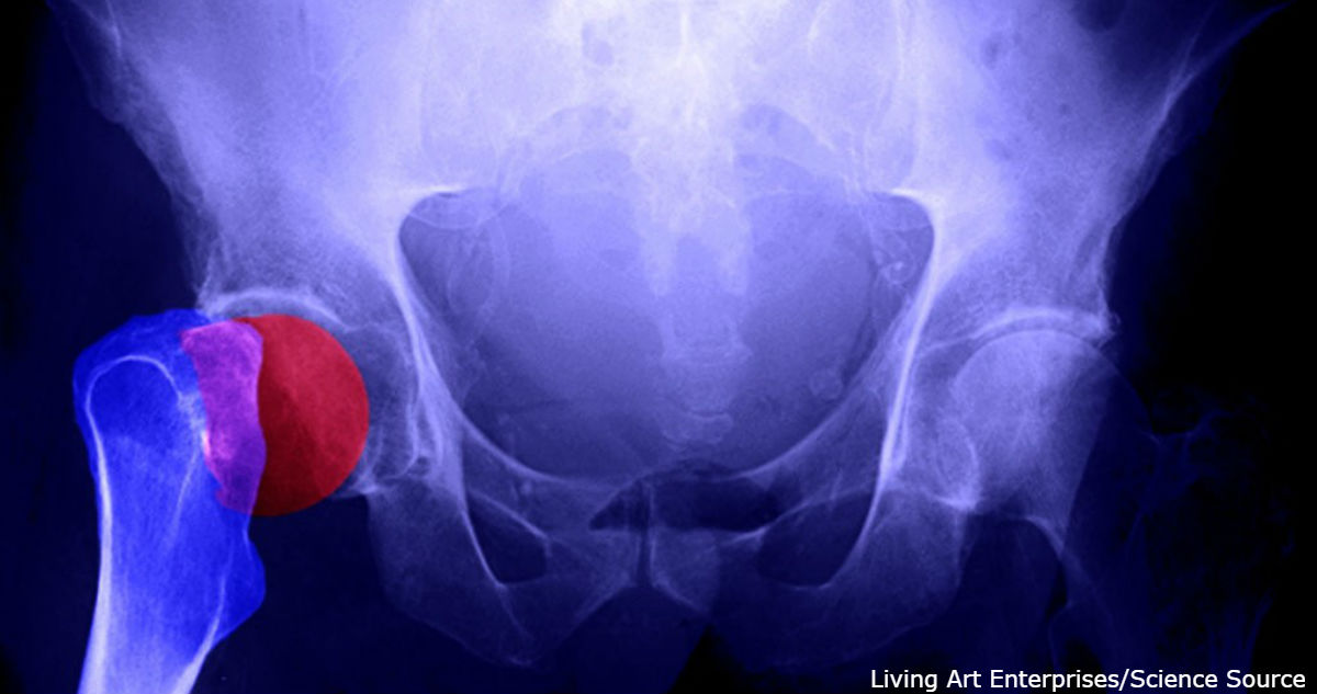 Большинство лекарств от остеопороза не помогают костям. Это – помогает
