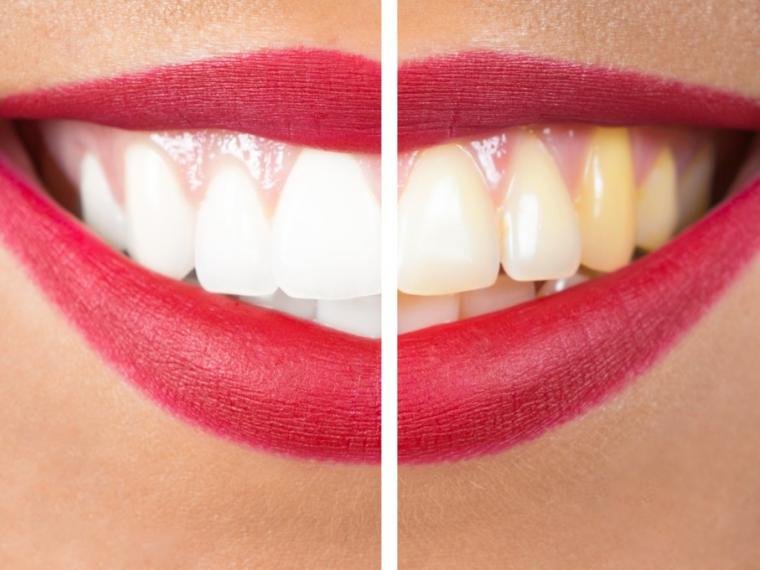 Голливудская улыбка: как сделать зубы белоснежными в домашних условиях