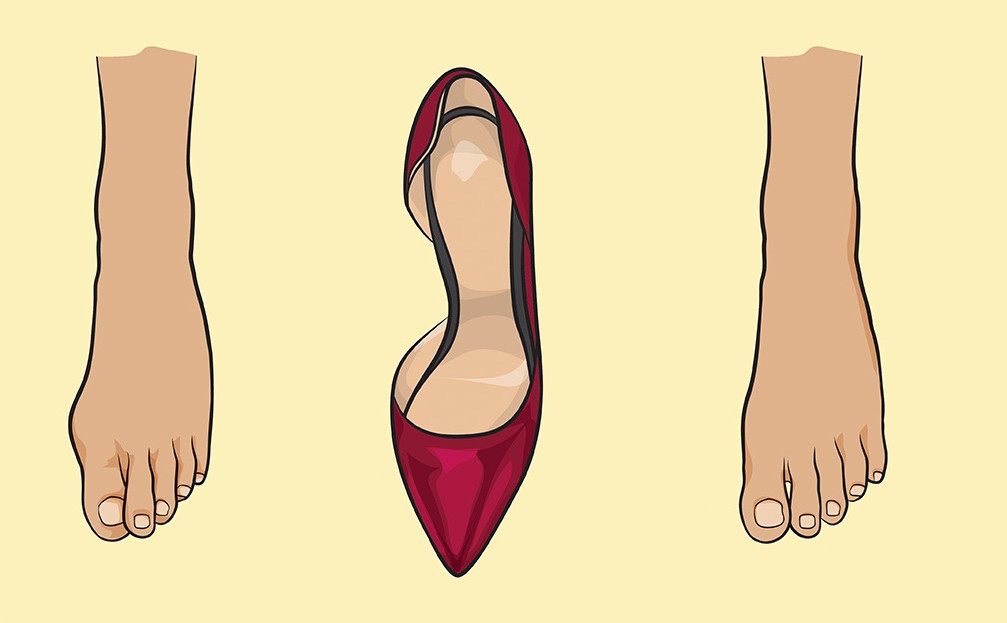 Деформация ног от узкой обуви