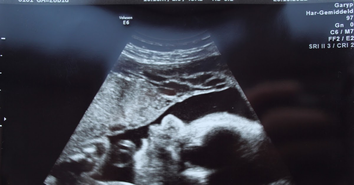 Фото узи мальчика 20 недель беременности
