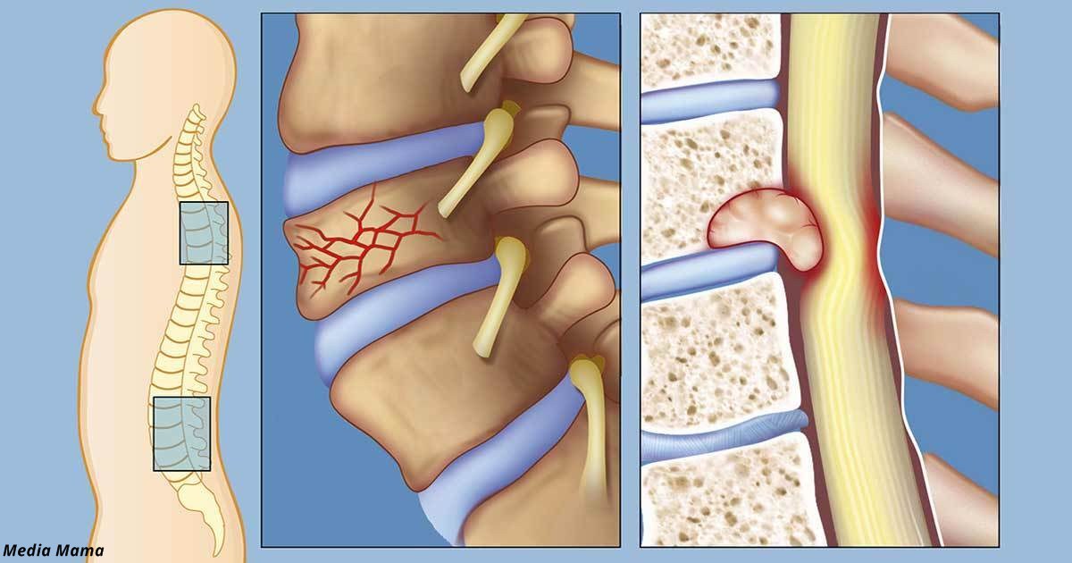 6 примеров, когда боль в спине может быть вызвана не просто усталостью — а серьёзными проблемами