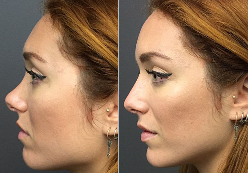 Ринопластика без операций: несколько способов изменить форму носа с помощью гимнастики и макияжа