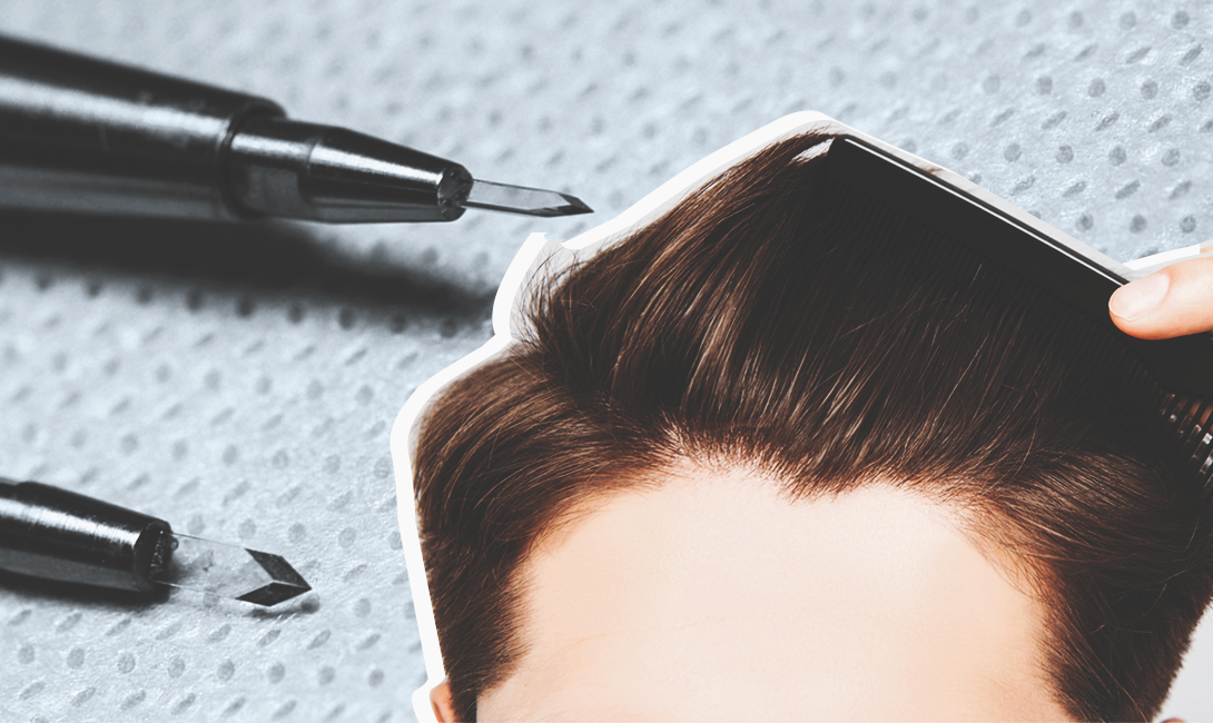 3 современных метода пересадки волос