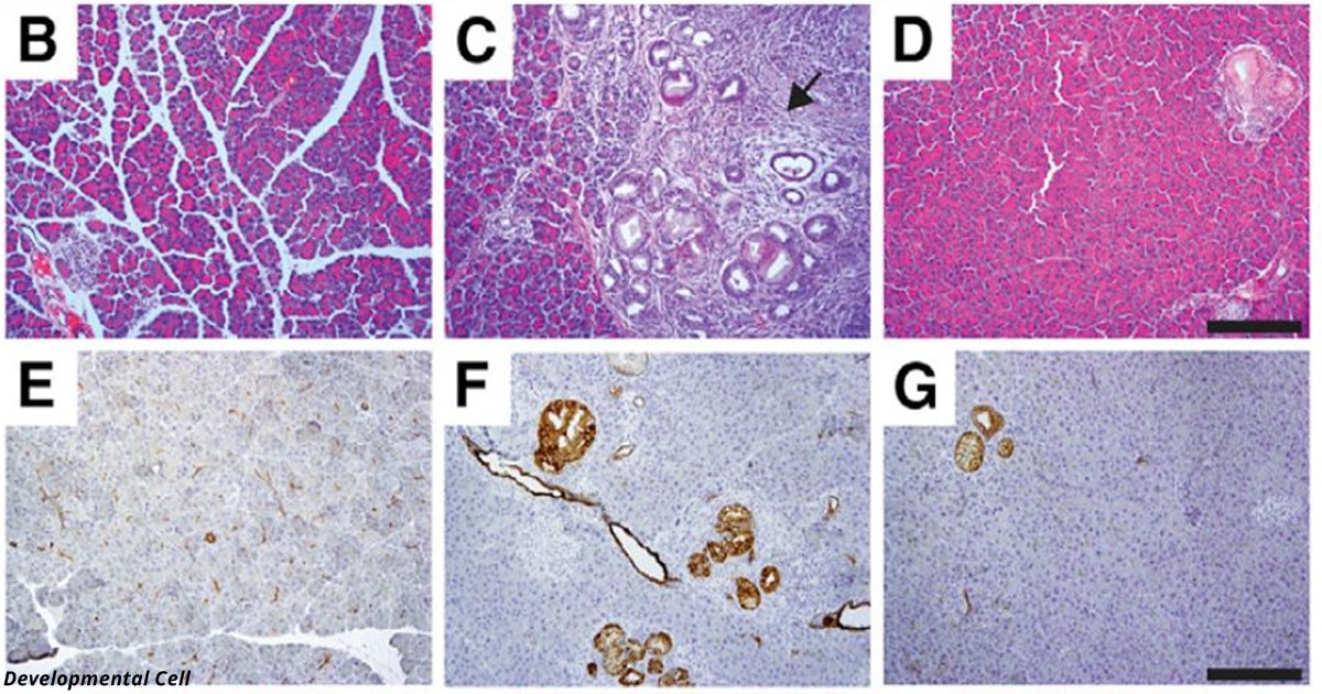 Учёные смогли «разубедить» превращаться в рак клетки поджелудочной железы