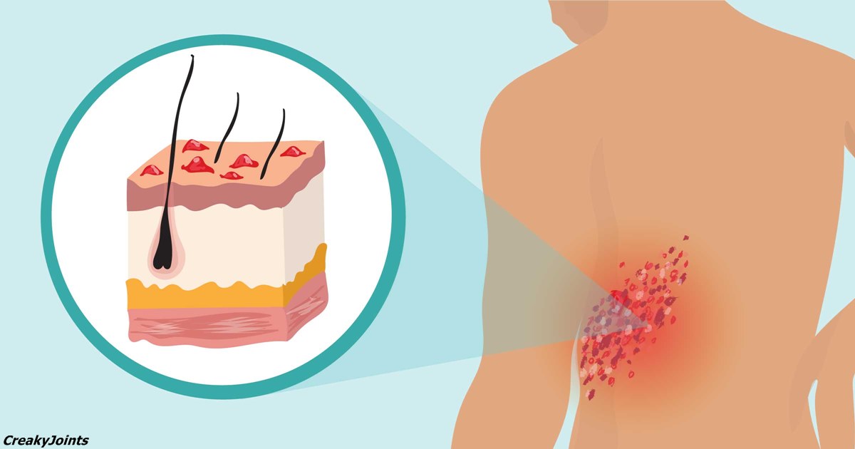 Опоясывающий лишай — болезнь, которая «оживает», когда вы под сильным стрессом