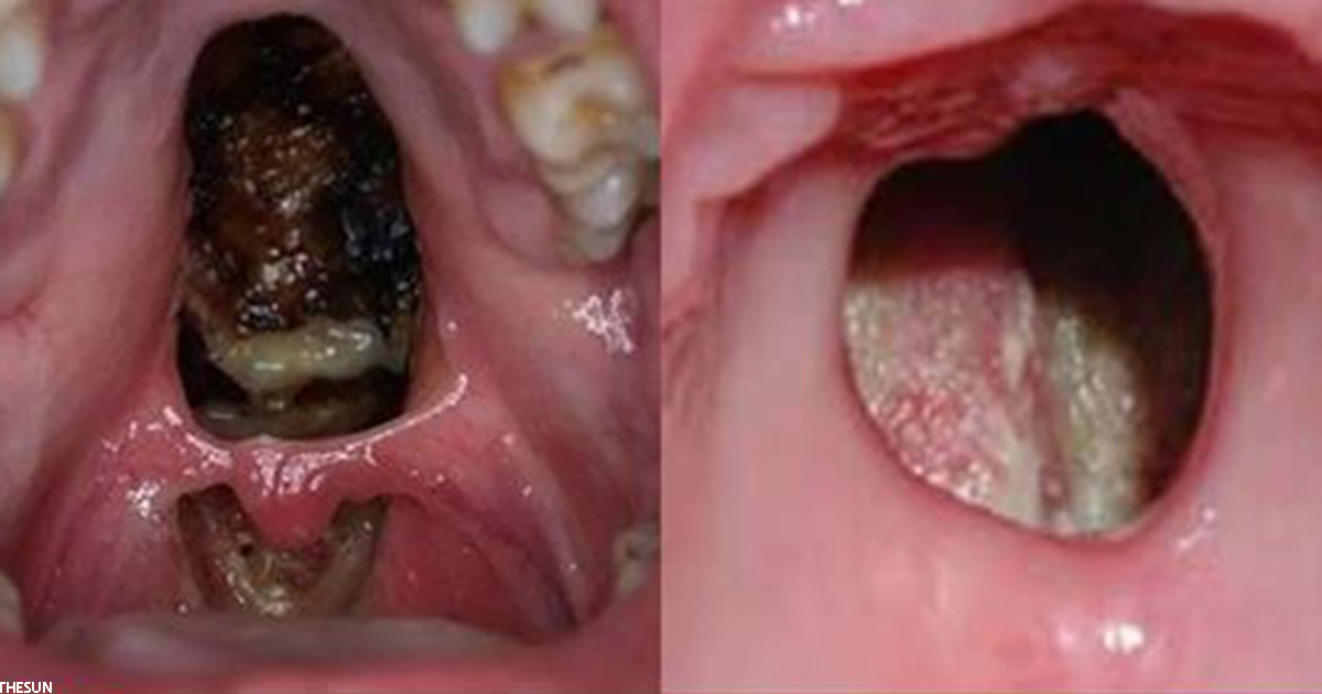 Ужасные фото показывают, что делает кокаин со слизистой оболочкой рта