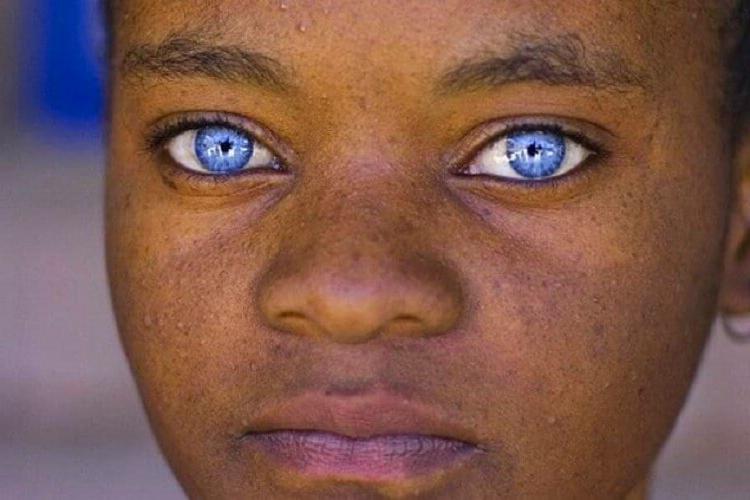Редчайшее чудо природы: как выглядят темнокожие дети, рожденные с голубыми глазами