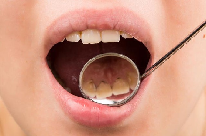 Подруга стоматолог рассказала, как избавиться от зубного налета в домашних условиях с помощью соды