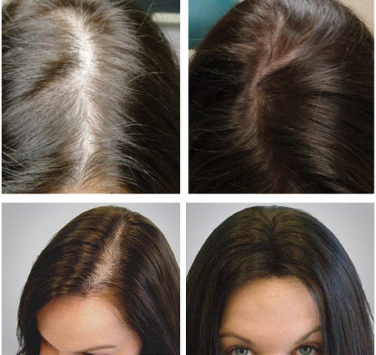 Сезонное обострение: косметолог рассказал, почему нужно сделать мезотерапию волос именно в это время года