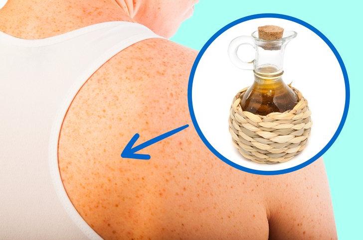 11 способов быстро и безболезненно удалить темные пятна с вашей кожи: апельсиновая корка, кокосовое масло и другие методы