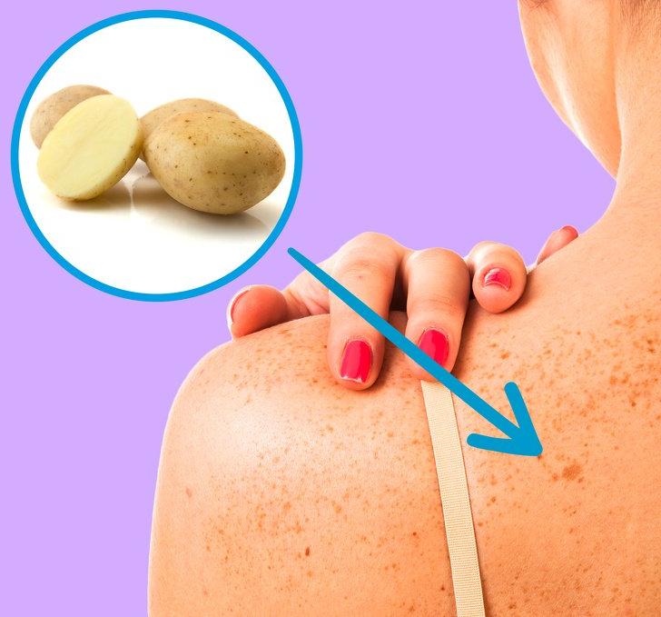 11 способов быстро и безболезненно удалить темные пятна с вашей кожи: апельсиновая корка, кокосовое масло и другие методы