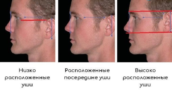 Уши выше носа. Высокое расположение ушей. Нормальное расположение ушей.