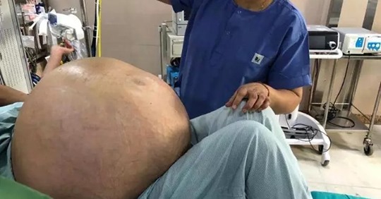 52 летней жительнице Индии удалили опухоль яичников весом 50 кило