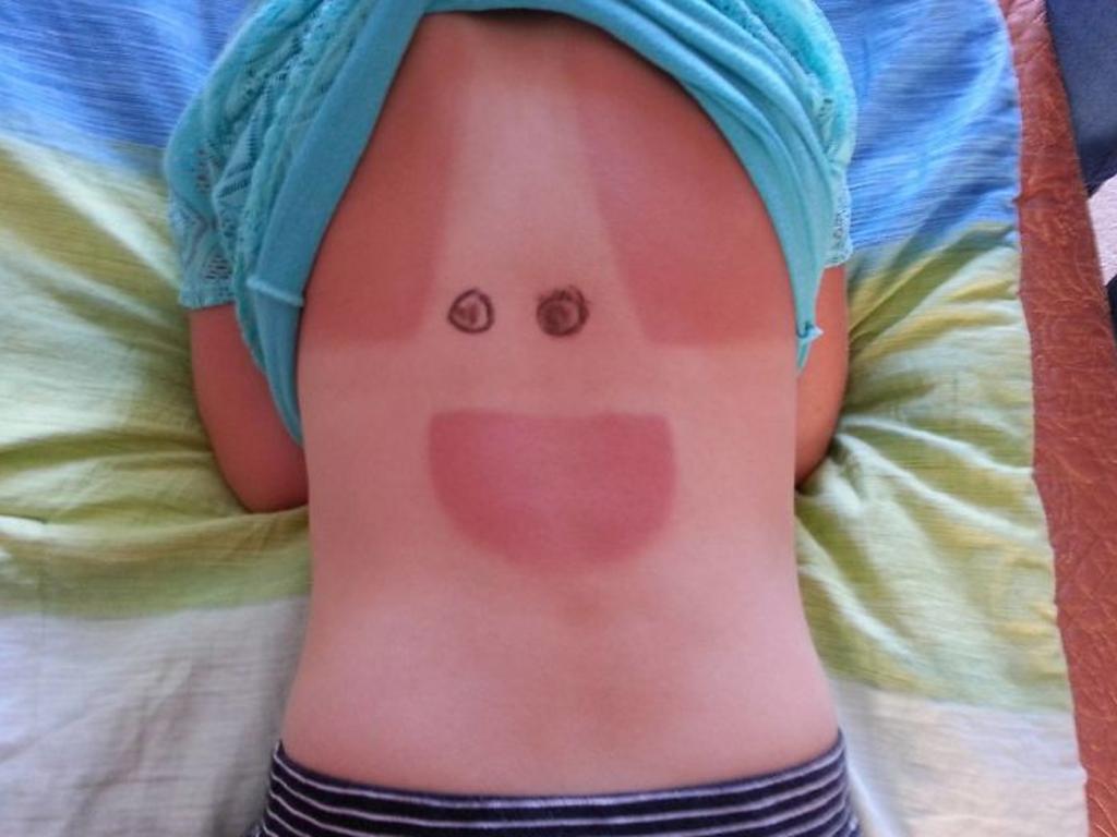 Коварное солнце: 9 людей, которые получили смешной загар этим летом