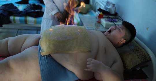  11 летний китаец весом 150 килограммов пытается похудеть с помощью огня