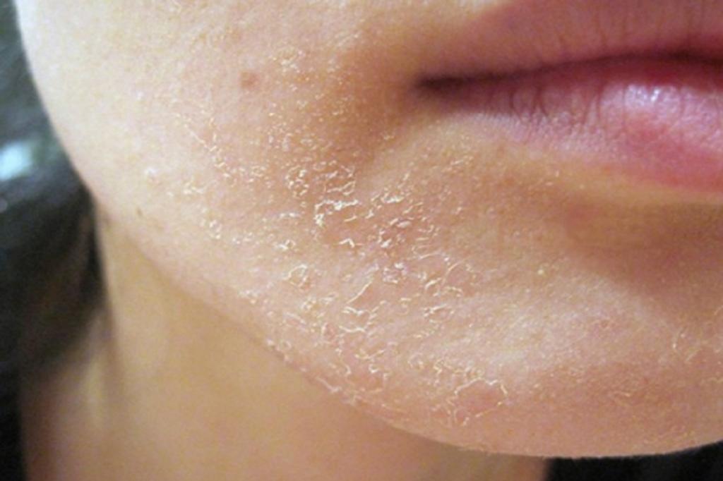 Шелушение, сухость, грубая кожа, потрескавшиеся губы и другие типичные зимние проблемы красоты: как это исправить (советы экспертов)