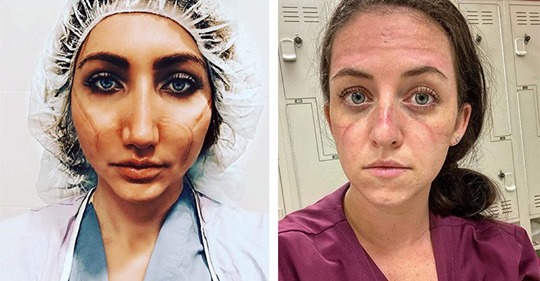 «Эти раны не пройдут — они останутся внутри нас»: фото девушек медиков со следами от масок на лицах