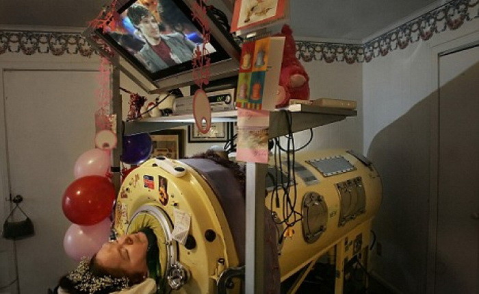Жизнь в «танке»: женщина провела почти 60 лет в аппарате вентиляции легких