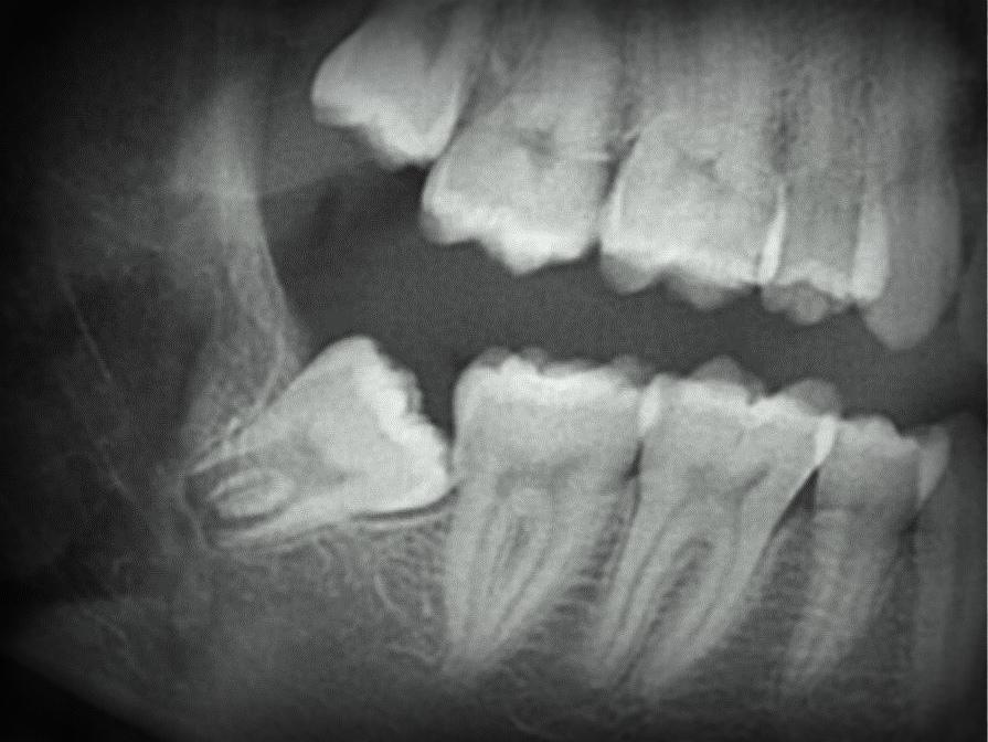 Удаление зуба семерки