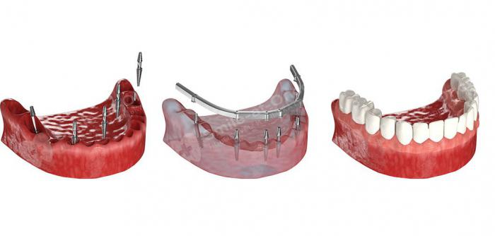 Новые зубы за 3 дня – базальная имплантация нового поколения