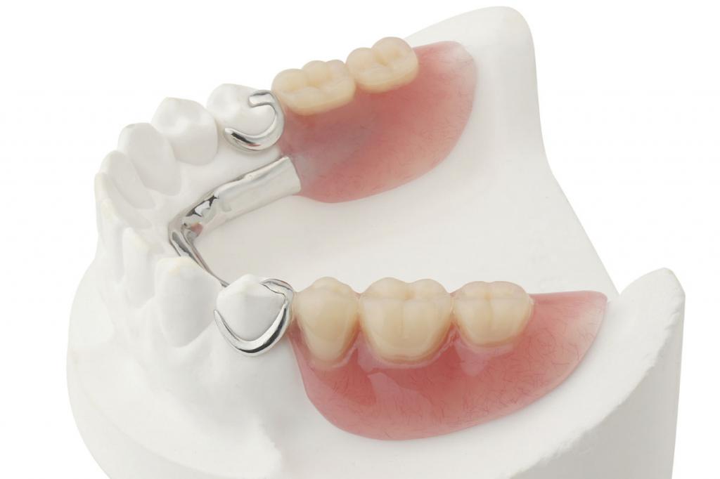 Зубные бюгельные протезы: отзывы и фото