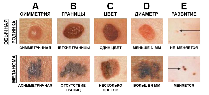 Этот Детектор Рака Кожи может спасти вашу жизнь. Запомните и поделитесь с близкими!