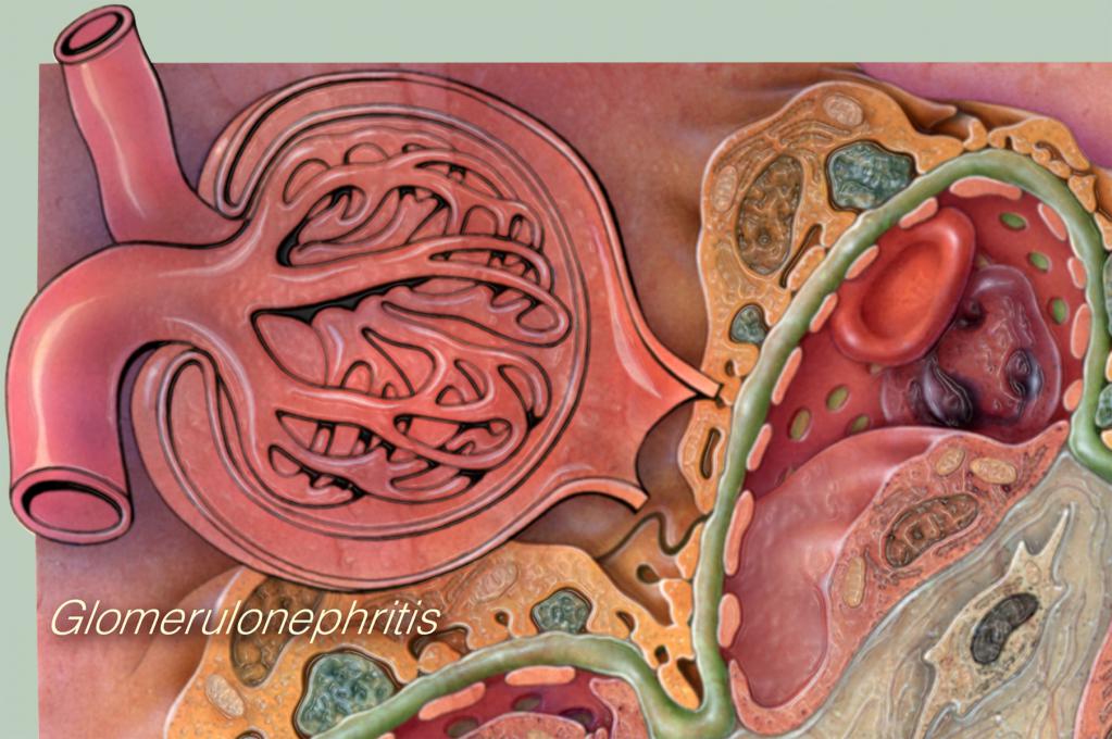 Гломерулонефрит: лечение, симптомы, диагностика и профилактика заболевания